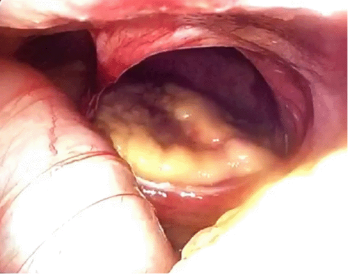 Diaphragmatic defect was visualized intraoperatively; heart could be visualized through defect on left side of diaphragm