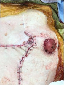 Figure 3. Stoma relocation and reconstruction