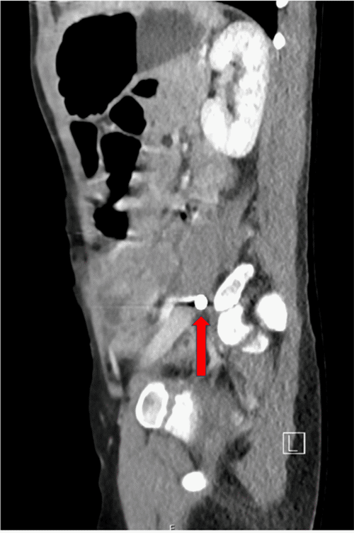 (B) Sagittal view of CT abdomen and pelvis showing the retained 9mm ballistic fragment