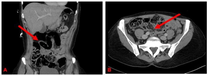 Loops of mildly dilated distal small bowel with focal transition point in the right lower quadrant (denoted by arrows), in coronal (A) and axial (B) planes, consistent with acute-on-chronic small bowel obstruction