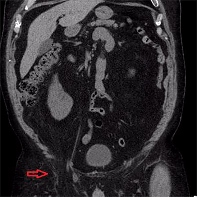 Figure 2. Coronal view of same study showing retroperitoneal and extraperitoneal fat extending into the right inguinal hernia.