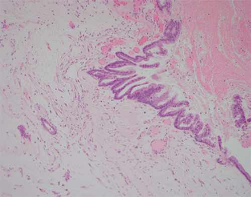 H&E stain (10x original magnification) of the pancreatic tumor. This field demonstrates features of a low-grade mucinous carcinoma characterized by atypical epithelial cells forming glandular structures and infiltrating ducts embedded within a desmoplastic stroma