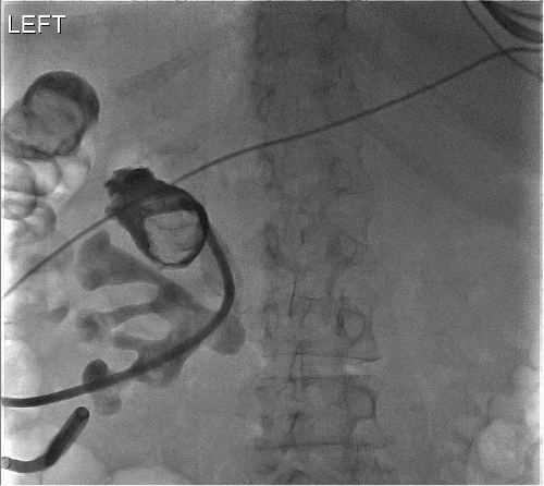 B) filling defect in left upper pole calyx consistent with fungal ball or abscess ball