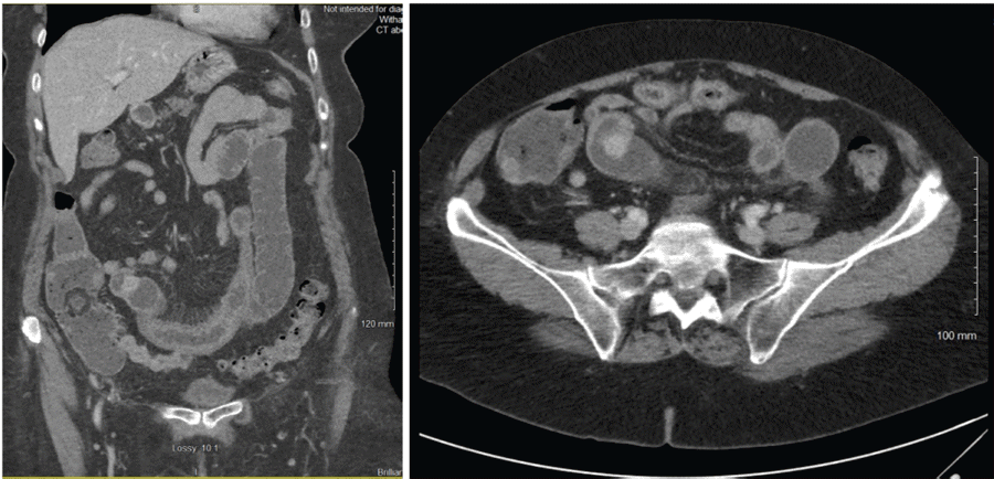 A) Coronal plane of abdominal CT scan showing jejunal mass causing a partial bowel obstruction; and B) CT abdomen/pelvis axial view showing jejunal mass