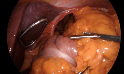 This image captures a moment during the meticulous reduction of herniated contents, showing loops of bowel and portions of solid organs being carefully mobilized and returned from the mediastinum through the large diaphragmatic defect into the abdominal cavity