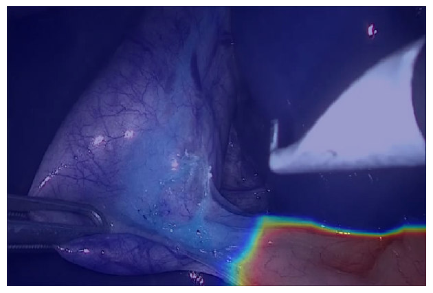 Figure 2: Examples of a convolutional neural network that is capable of providing real-time predictions during a laparoscopic cholecystectomy for the GO zone (safe area to dissect) and NO-GO zone (dangerous area to dissect in with a high likelihood of major bile duct injury). 