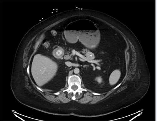 Axial CT image demonstrating a gallstone within a small bowel loop in the right upper quadrant