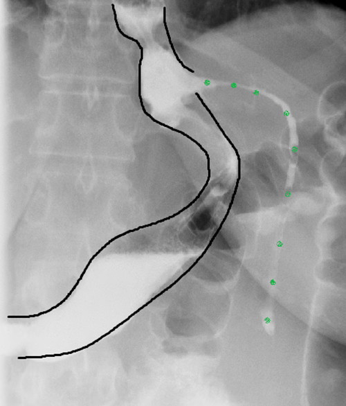 A Minimally Invasive Approach to Persistent Gastric StapleLine Failure ACS