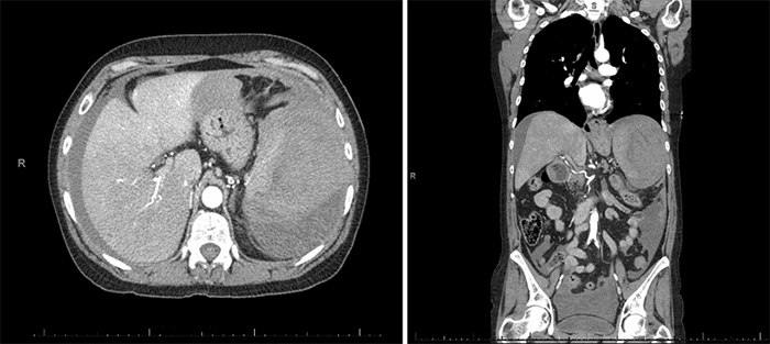Heterogeneous appearance of the spleen, with complex fluid in the left upper quadrant and free fluid in the abdomen and pelvis