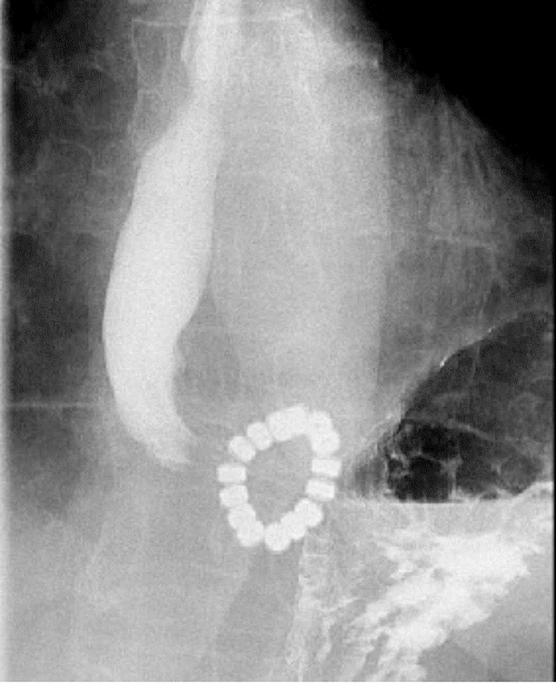 Illustrating discontinuity in the posterior section of the LINX device during contrast passage. A) Pre-contrast image shows the LINX device in its intact state