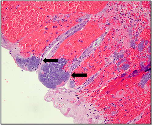 A) High power (40x): Multiple foci of mucosal involvement by Actinomyces spp. with marked submucosal hemorrhage. Areas of mucosa involved by Actinomyces are almost completely destroyed and associated with marked submucosal hemorrhage. Actinomyces in submitted sections do not appear to invade beyond submucosa.