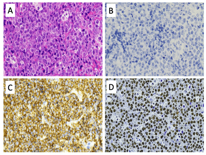 A) Hematoxylin and eosin: sheet-like infiltration of plasmablastic cells; B) CD20: lymphoma cells negative; C) CD138: lymphoma cells positive; and D) Epstein-Barr encoding region (EBER) in situ hybridization: lymphoma cells positive.