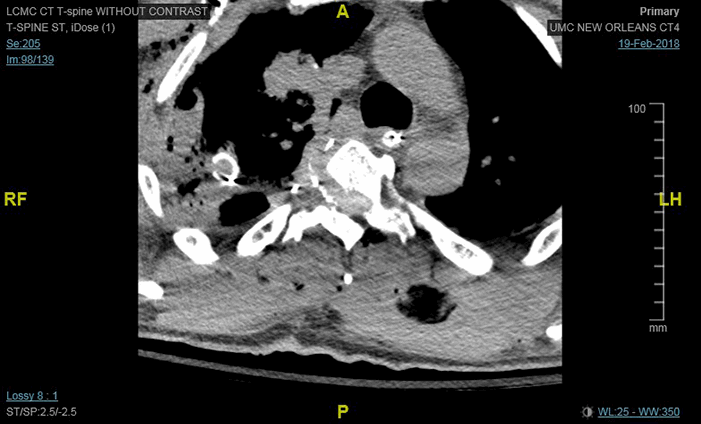 Figure 5. CT thoracic spine without contrast: axial view
