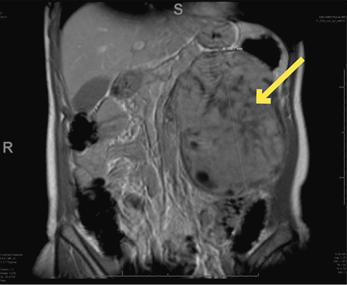 C) Image depicting coronal at its largest dimensions