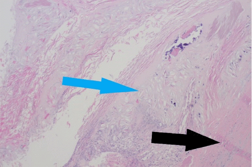 B) Keratin debris in the center of the cyst (blue arrow); and fibrous cyst wall (black arrow)