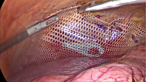 C) Composite Mesh Applied After Defect Closure