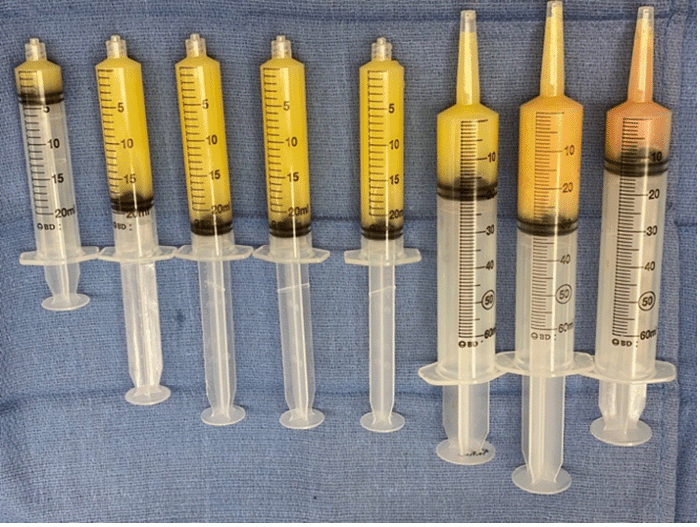 Approximately 125 mL of periprosthetic fluid was drawn from right capsule and sent for pathology and flow cytometry
