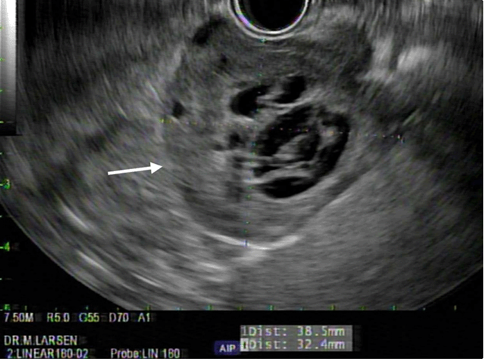 Endoscopic ultrasound demonstrating 3.8 × 3.2 cm hypoechoic, multicystic, lobulated mass arising from lesser curvature of stomach