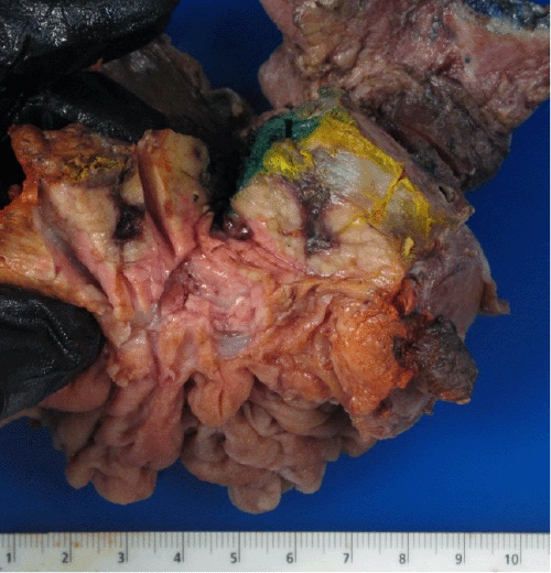 Vascular margin inked yellow, uncinate black, posterior orange, and neck blue. At the vascular margin, the continuity from the pancreatic parenchyma to the vein consistent with fistula formation to the SMV is evident