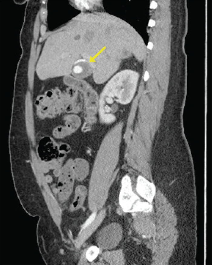 Hepatic Artery Aneurysms: An Uncommon Presentation of a Deadly Disease ...