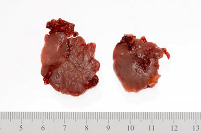 Figure 2. Right adrenal gland with 3.7 x 3.5 x 3.0 cm nodule with pathology suggestive of metastatic papillary thyroid carcinoma