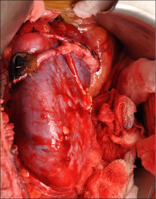 A) Implanted Kidney after Reperfusion