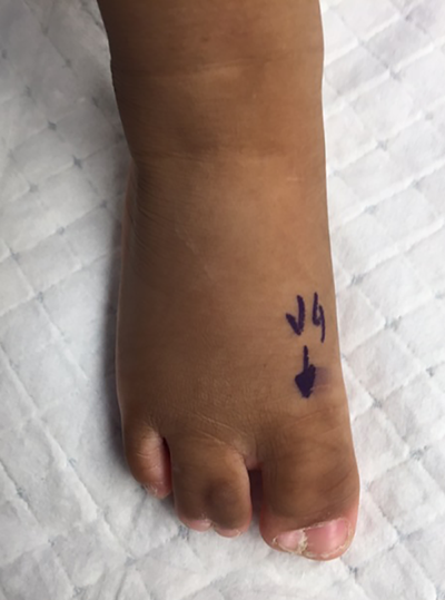 Figure 9. Complete syndactyly of the 1st and 3rd web spaces of right foot.
