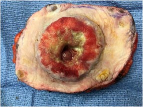 Figure 2. Local excision of stoma and surrounding tissues