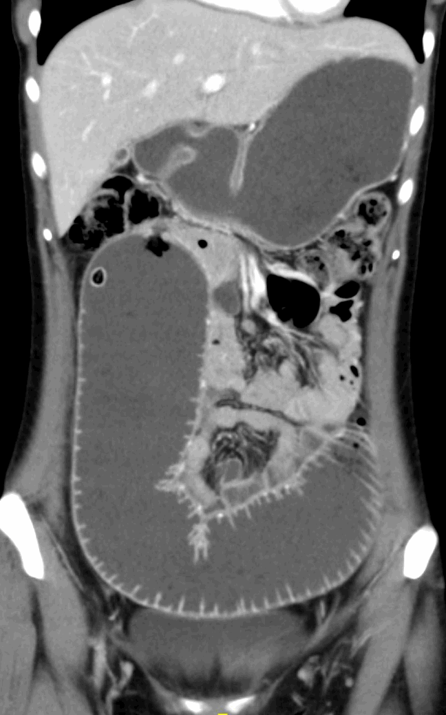 Figure 1. Preoperative Computed Tomography (CT) Abdomen Pelvis with Contrast. A chronically distended proximal jejunum with a narrowed lumen visible in the RUQ at the lateral edge of the dilated jejunum