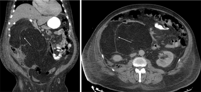 Arrows denote internal septations of retroperitoneal mass.