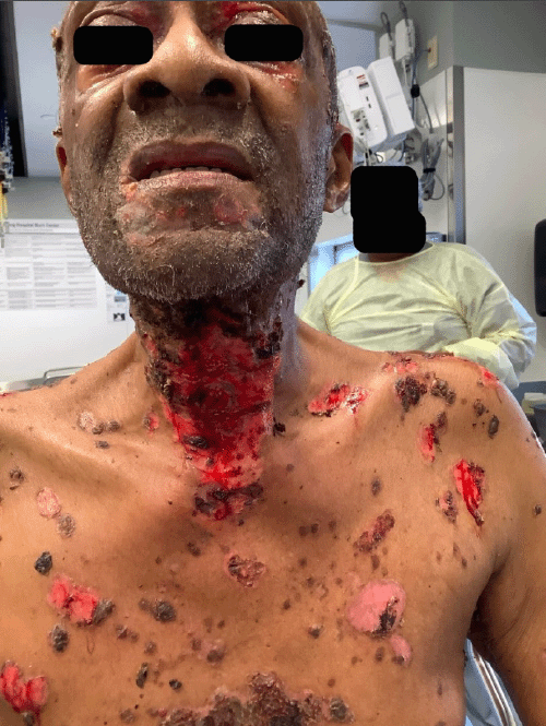 Clinical photograph (anterior view) demonstrating diffuse cutaneous lesions characteristic of pemphigus vulgaris. Note the involvement of the head, neck, and thorax, with lesions in mixed stages of wound healing, including bullae, erosions, and crusted areas. Ocular mucosal involvement is partially visible at the eyelids