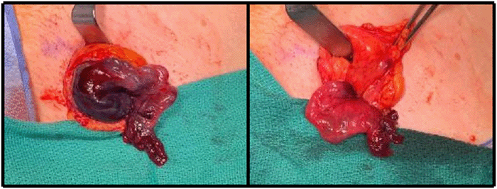 A) Open McVay repair exposing the femoral defect. The hernia sac contents include an ischemic-appearing left fallopian tube; B) left fallopian tube after hernia sac decompression and detorsion, demonstrating improved viability