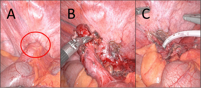 Composite of intraoperative images. (A) The appendiceal tip is seen densely adhered to the right pericolic gutter. (B) The appendix has been dissected from the retroperitoneum, revealing evidence of a chronic fistulous tract at its base. (C) A surgical drain is inserted into the residual retroperitoneal abscess cavity following appendectomy