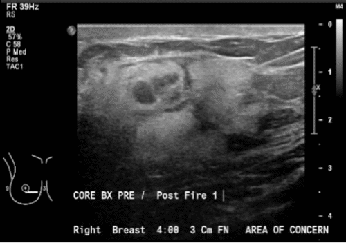 A) Hyperechoic mass with nodules within breast parenchyma