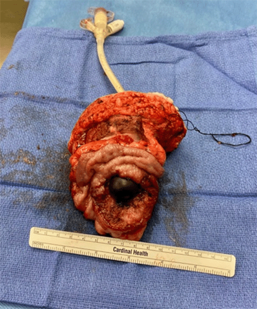 B) specimen of en-bloc resection