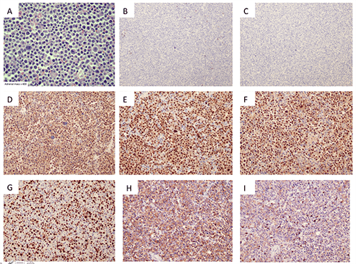 Figure 3. Immunohistochemistry showing plasmablastic lymphoma of the adrenal gland. A: Sheets of pleomorphic and discohesive cells with hyperchromatic nuclei and prominent nucleoli [hematoxylin and eosin (H&E) staining, mag x 400]; B: Dysplastic cells were negative for B-cell marker CD20 [mag x 200]; C: Dysplastic cells were negative for synaptophysin, a neuroendocrine tumor marker [mag x 200]; D: Dysplastic cells were positive for the plasma cell marker CD138 [mag x 200]; E: Dysplastic cells were positive for the plasma cell marker MUM-1 [mag x 200]; F: Nuclei of the dysplastic cells were positive for Epstein Barr virus encoded RNA [mag x 200]; G: Dysplastic cells were positive for Ki-67 [mag x 200]; H: Positive markers show plasma cells expressing Lambda light chains [mag x 200]; I: Positive markers show Kappa light chain restriction, [mag x 200].