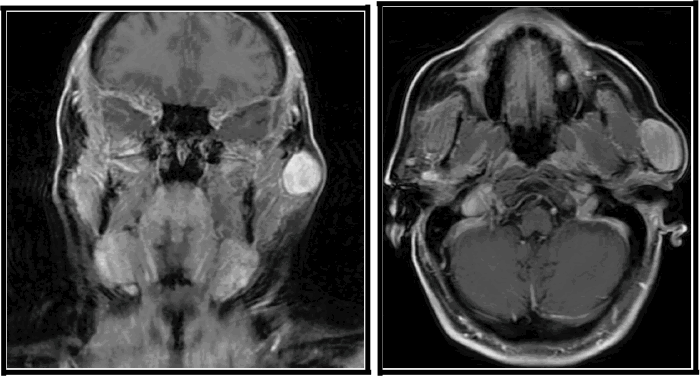 (A) Coronal view and (B) Axial view demonstrating a well-circumscribed, avidly enhancing, oval-shaped soft tissue mass, measuring approximately 3.3 × 2.1 cm. The lesion appears to arise from or is immediately adjacent to the superior pole of the superficial lobe of the left parotid gland, without definitive invasion of surrounding structures