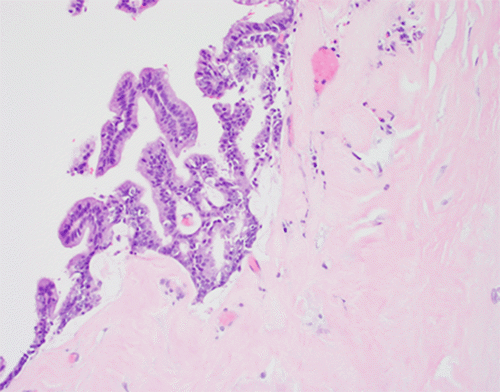 H&E stain (20x original magnification) showcasing the neoplastic epithelium of the low-grade mucinous carcinoma. Note the presence of focal cribriform architecture (gland-in-gland formation) and the surrounding dense desmoplastic stroma