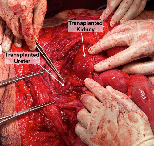 Intraoperative photograph showing the carefully dissected and identified transplanted kidney and ureter (ureter indicated at the tip of the forceps) within the right lower quadrant operative field