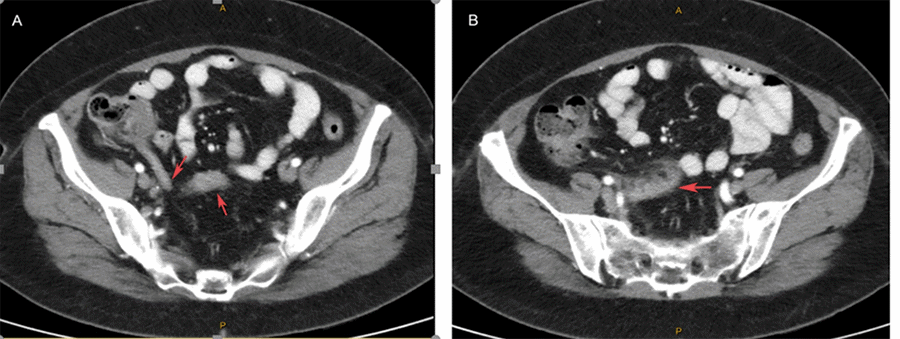 Images demonstrate normal proximal appendix thickening distally (2A, arrow) with associated distal fat stranding and fluid (2B, arrow).