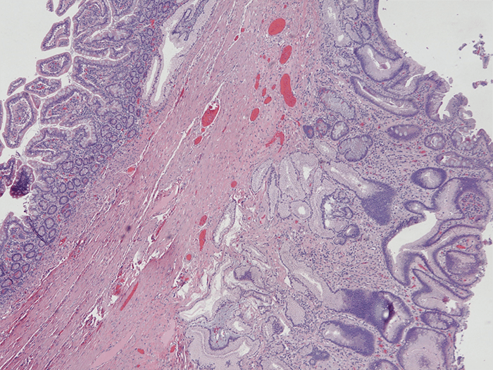 Figure 4. Histology of Resected Small Bowel with Gastric Heterotopia. Normal small bowel mucosa (left) and heterotopic gastric antral type mucosa (right). Hematoxylin & Eosin (H&E) stain, 40x magnification.