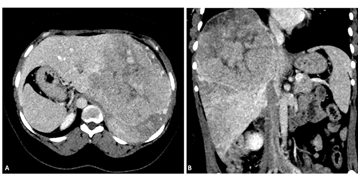 (A) Axial view demonstrating significant tumor compression, mass effect, and perfusion anomaly in segment 6, along with a perfusion defect in the inferior vena cava. (B) Coronal view highlighting the same findings
