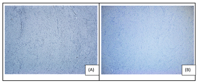 A, ER) shows weak cytoplasmic positivity in approximately 20% of the cells; B, PR demonstrates moderate cytoplasmic positivity in 20% of the cells. Additionally, the figure reveals background changes suggestive of gynecomastia