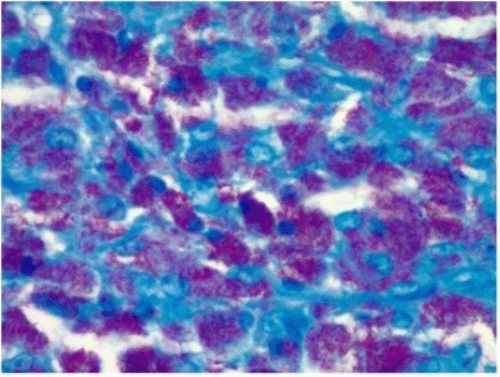 (C) Ziehl-Neelsen (acid-fast bacillus) stain, 45x magnification