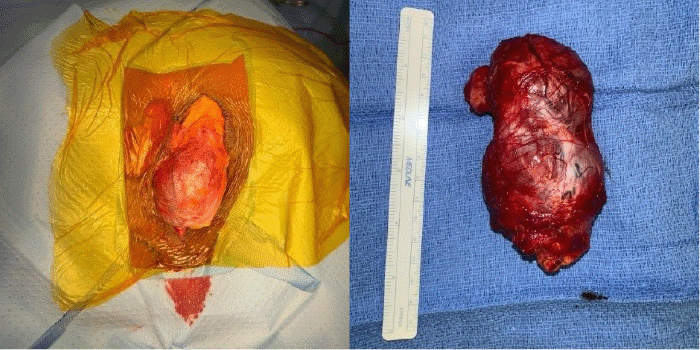 Intraoperative photographs from the trans-perineal excision. (A) Initial dissection reveals the encapsulated, well-circumscribed, multilobulated soft tissue mass situated within the ischiorectal fat pad. (B) The completely excised surgical specimen, highlighting its distinct lobulations and firm, fibrous/muscular appearance with noticeable surface vascularity