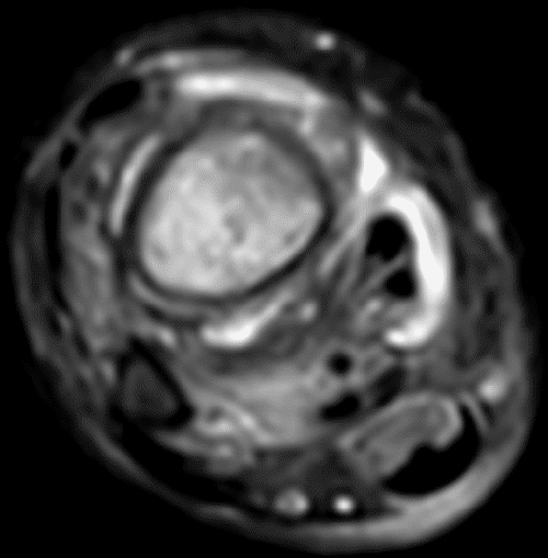 B) axial T2 fat-suppressed MRI through the distal lower leg showing bone marrow edema in the tibia but not the fibula, soft tissue edema surrounding the tibia, and periosteal new bone along the lateral aspect of the tibia