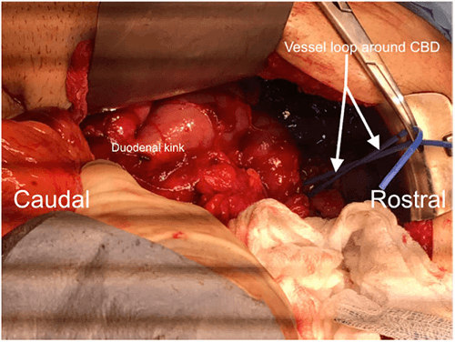 Figure 3: Small bowel in the right upper quadrant and a high lying cecum, CBD is common bile duct. 