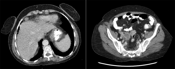 (A) Axial CT scan of the abdomen and pelvis showing a soft tissue density interposed between the liver and anterior abdominal wall; (B) Mass-like enlargement of the appendix concerning for malignancy