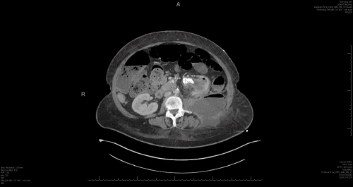 B) Large 3.3 cm staghorn calculus in the left kidney, resulting in severe left hydronephrosis and likely calyceal rupture