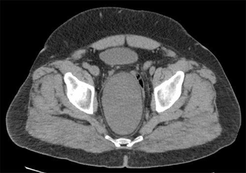 B) CT imaging of pelvis showed large, well-circumscribed oval mass in deep pelvis posterior and lateral to rectosigmoid, which extended into right ischiorectal fossa. Measured 11.9 × 7.5 × 14.9 cm. Internal density of mass was 17 Hounsfield units.